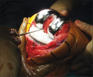 Illustration 10 for Posterior Cruciate Ligament-Retaining TKA: Navigating Pitfalls