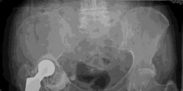 Revision Hip Success: Unpacking The Case Title Acetabular Grafting