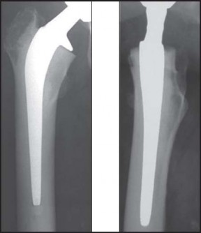 توضيح طبي: استبدال مفصل الورك الكلي بتقنية الإسمنت للفخذ: دليلك الشامل لنتائج تدوم طويلاً مع الأستاذ الدكتور محمد هطيف في صنعاء
