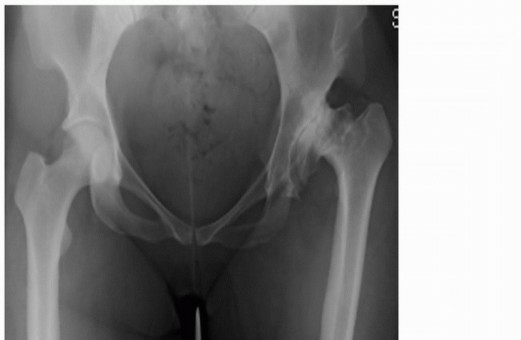 Mastering Femoral Head Autograft in DDH Hip Reconstruction