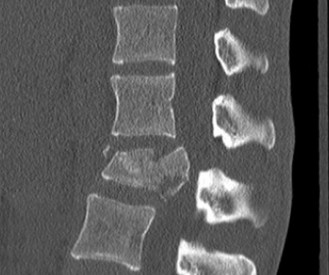 Illustration 7 for Spine Cases: Consider the Patient for Accurate Diagnosis