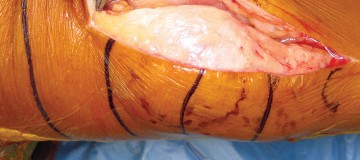 Illustration 10 for Minimize Pain, Maximize Recovery: TKA with Parapatellar