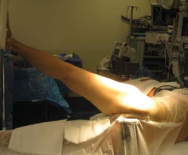 Illustration 2 for Posterolateral Surgical Approaches: Achieve Optimal Hip Replacement