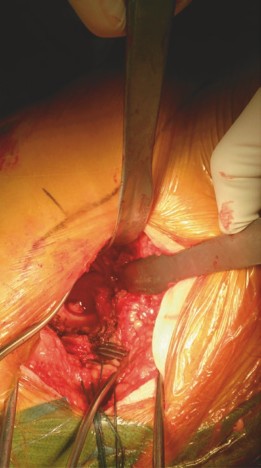 Illustration 8 for Mastering Direct Anterior Approach Hip Arthroplasty Without a Traction Table