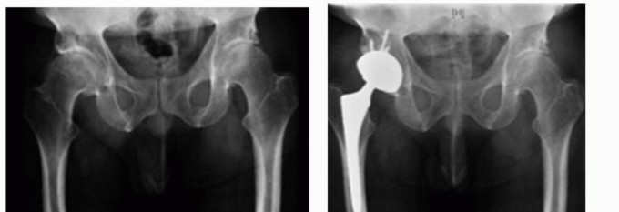 Total Hip Arthroplasty: Posterolateral Approach, Extensile & Minimally Invasive