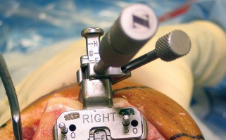 Illustration 21 for Minimize Pain, Maximize Recovery: TKA with Parapatellar