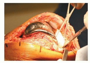 Removal of Well-fixed Components: Safe Techniques for Revision TKA