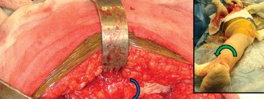 Illustration 20 for Mastering Soft Tissue Balancing for Optimal THR Outcomes