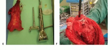 صورة توضيحية لـ الأطراف الصناعية القابلة للتمدد للأطفال: دليل شامل للمرضى حول الوقاية من العدوى والعلاج في صنعاء مع الأستاذ الدكتور محمد هطيف