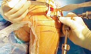 Illustration 31 for Knee Arthroplasty: Avoiding Pitfalls & Benefiting from UKA