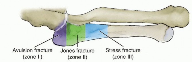 Illustration of proximal fifth metatarsal fracture - Dr. Mohammed Hutaif