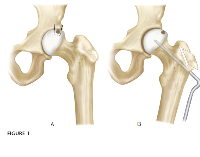 Illustration of intertrochanteric femoral osteotomy - Dr. Mohammed Hutaif