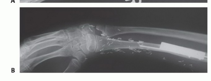 صورة طبية: ترقيع الشظية الوعائي الحر: حلول متقدمة لعيوب العظام المعقدة
