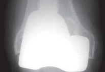 Illustration of grafting for defects - Dr. Mohammed Hutaif