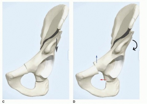 Illustration 24 for Periacetabular Osteotomy: Realigning your hip via the superior pubic ramus