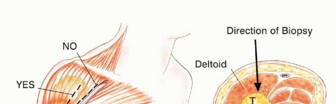 صورة طبية: استئصال أورام الكتف مع الحفاظ على الطرف: أحدث التقنيات لنتائج مثالية مع الأستاذ الدكتور محمد هطيف