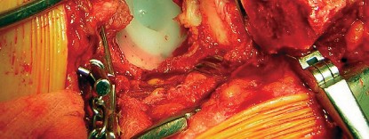 صورة طبية: طول عمر مكون الحُق الأسمنتي في مفصل الورك: مفتاح الاستقرار والديمومة مع الأستاذ الدكتور محمد هطيف في صنعاء