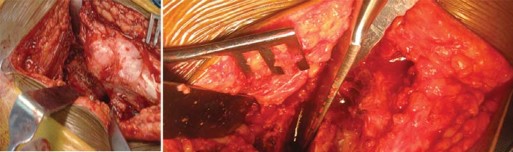 صورة طبية: استبدال مفصل الورك الكلي لالتهاب المفاصل الروماتويدي اليفعي: استعادة الحركة والأمل مع الأستاذ الدكتور محمد هطيف في صنعاء