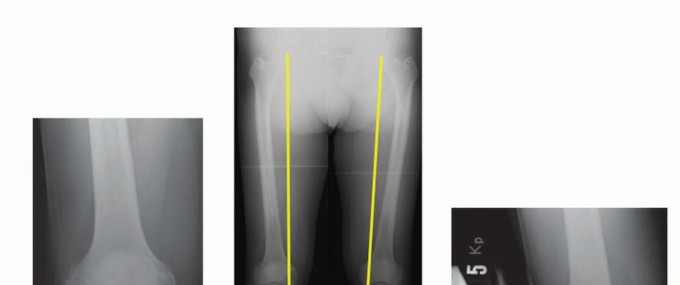 Illustration of compartmental knee oa - Dr. Mohammed Hutaif