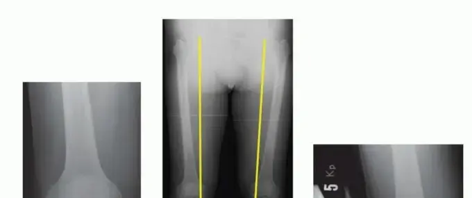 جراحة تقويم الركبة (قطع العظم الظنبوبي العالي): حل دائم لآلام الركبة في اليمن والخليج