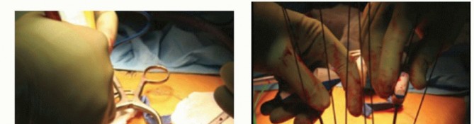 Illustration of percutaneous pedicle screw - Dr. Mohammed Hutaif