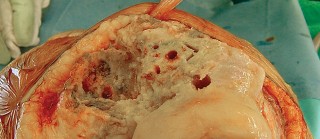 Illustration 22 for Revision of Failed UKA: Your Guide to Successful Treatment