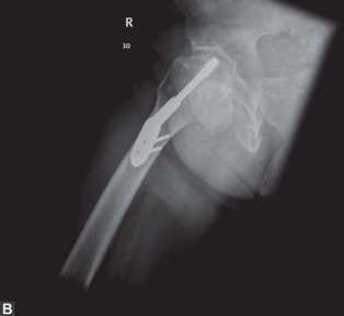 صورة توضيحية لـ جراحة استبدال مفصل الورك في كسور الفخذ القريبة: دليل شامل للمرضى مع الأستاذ الدكتور محمد هطيف