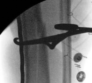 Illustration 27 for Tibial Fracture Extending into the Plafond: Intramedullary Secrets