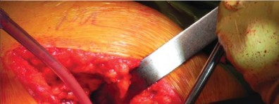 صورة طبية: تقنية الجذع القصير لاستبدال مفصل الورك الكلي: نهج الأستاذ الدكتور محمد هطيف لتدخل جراحي أقل ونتائج أفضل