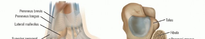 Stop Recurrent Lateral Ankle Instability: Peroneal Tendon Repair