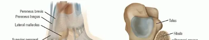 أوتار الكاحل المنزلقة (الشظية): دليلك الشامل للتشخيص والعلاج والتعافي مع الدكتور محمد هطيف