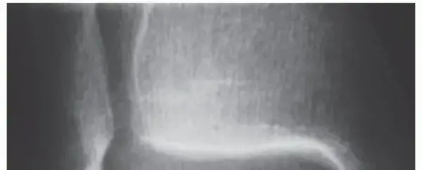 انفصال الغضروف العظمي في الكاحل: دليلك الشامل لاستعادة الحركة والعلاج مع الأستاذ الدكتور محمد هطيف