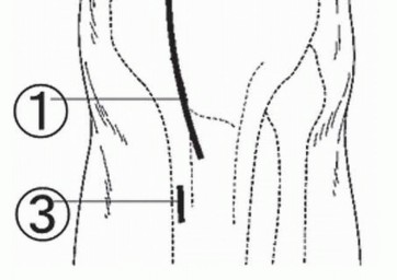 Illustration 6 for High Tibial Osteotomy: Realignment for Lasting Knee Pain Relief