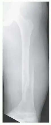 كسور عظم الفخذ: دليل شامل للمرضى حول العلاج والتثبيت الخارجي مع الأستاذ الدكتور محمد هطيف