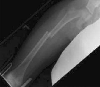 Illustration 2 for 8 Pediatric Cases: Critical Decisions on Exits from the Physis