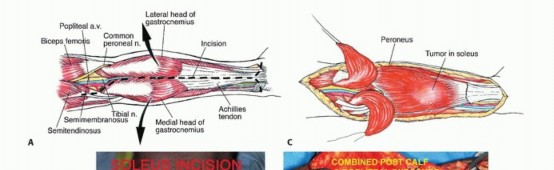 صورة توضيحية لـ استئصال ورم العضلة النعلية: دليل شامل لحماية عضلة الساق والتعافي الكامل في صنعاء مع الأستاذ الدكتور محمد هطيف