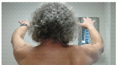 Illustration of thoracic nerve palsy - Dr. Mohammed Hutaif