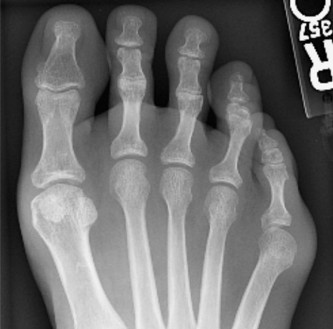 Illustration of lateral condylar resection - Dr. Mohammed Hutaif