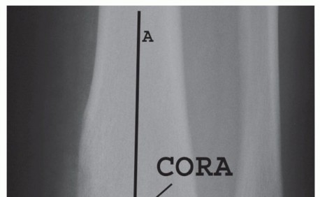 Illustration of closing wedge osteotomy - Dr. Mohammed Hutaif