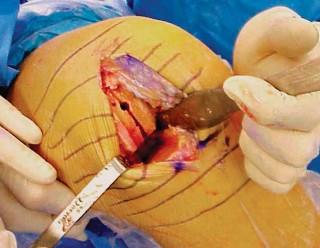 Illustration 67 for Unicompartmental Knee Arthroplasty: Master decisions with this b c figure guide.