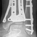 Illustration 27 for Decoding Pilon Fractures: Anterolateral and Medial Fragments Revealed