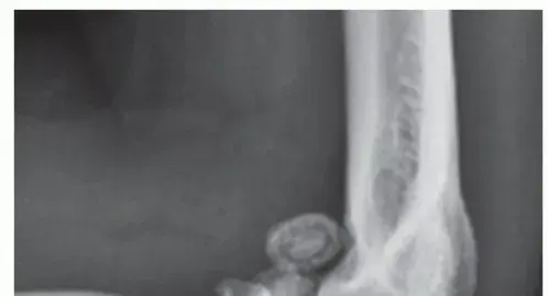 وداعاً لألم خشونة الكوع: دليل المريض الشامل لعلاج واستبدال مفصل الكوع مع الأستاذ الدكتور محمد هطيف