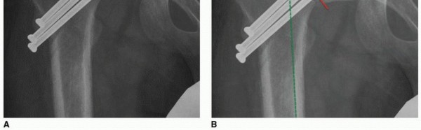 Illustration 26 for Periacetabular Osteotomy: Realigning your hip via the superior pubic ramus