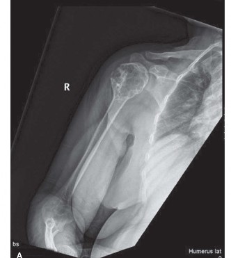 Illustration of orthopedics oncology cases chondrosarcoma - Dr. Mohammed Hutaif
