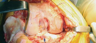 Illustration 52 for Mastering TKA: Essential Methods of Rotational Alignment