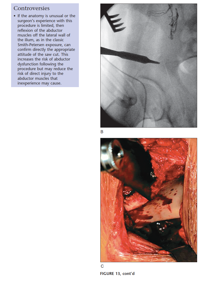 Illustration 29 for Bernese PAO: Unlocking the Procedure with Level V Evidence Insights