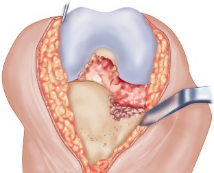 Illustration 52 for Unicompartmental Knee Arthroplasty: Master decisions with this b c figure guide.