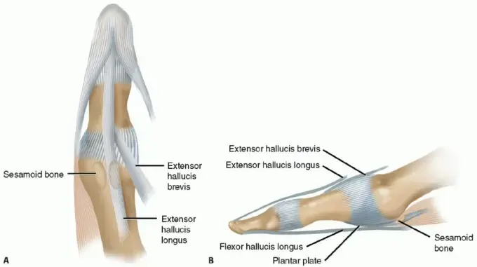 صورة توضيحية لـ تثبيت مفصل إبهام القدم الكبير: حل جذري لألم القدم المزمن والتشوهات