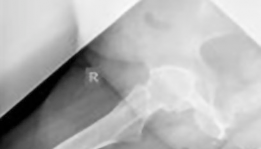 Illustration 3 for Hybrid Primary Total Hip: A Solution for Complex Joint Pain