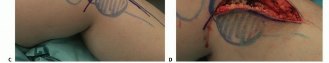 صورة بالأشعة السينية تظهر ورمًا في العظم